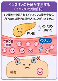 インスリン分泌低下.jpg